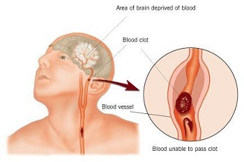 Explanation of a stroke.